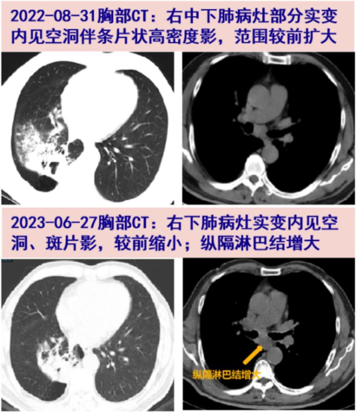当着主任的面吵起来了！痰培养阳性治疗2年仍诊断不明